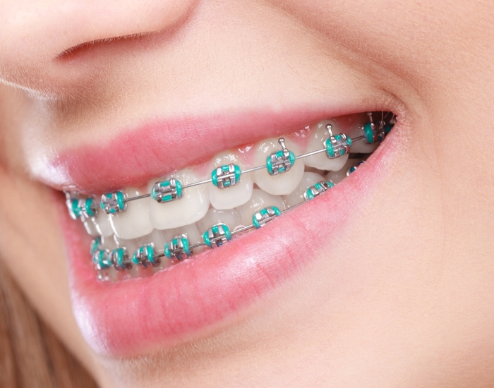 How Long Do Braces Take to Put On? Step-by-Step Guide