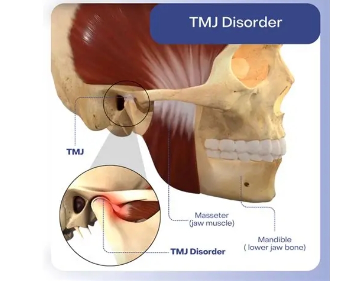 TMJ Disorder: Causes, Symptoms, and Effective Treatment Options