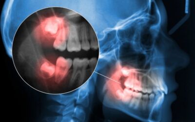 Does Every Person Have Wisdom Teeth? Here’s What You Should Know