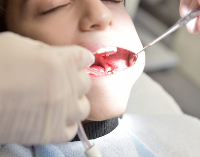 Full Mouth Reconstruction: Restore Function, Comfort & Confidence