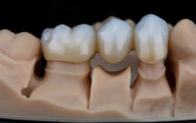 Tooth Pain After Crown Fell Off: What to Do