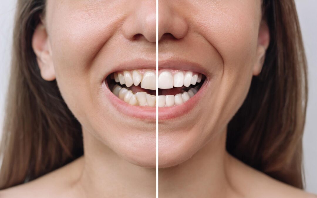 Veneers Before and After: How Veneers Work in Every Smile Situation