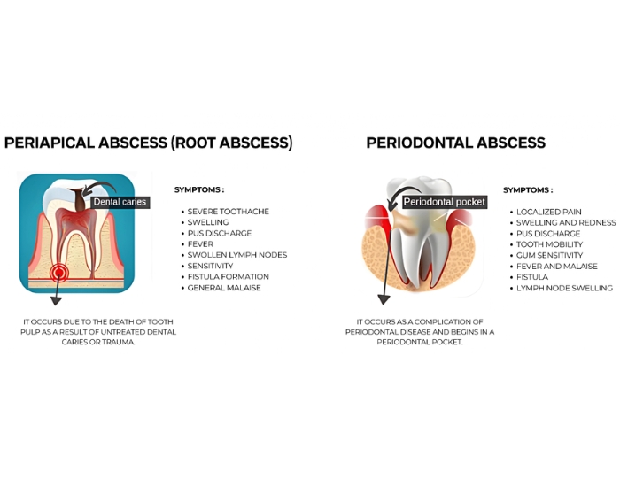 Do You Really Need a Root Canal? Signs You Might Not | Houston Guide