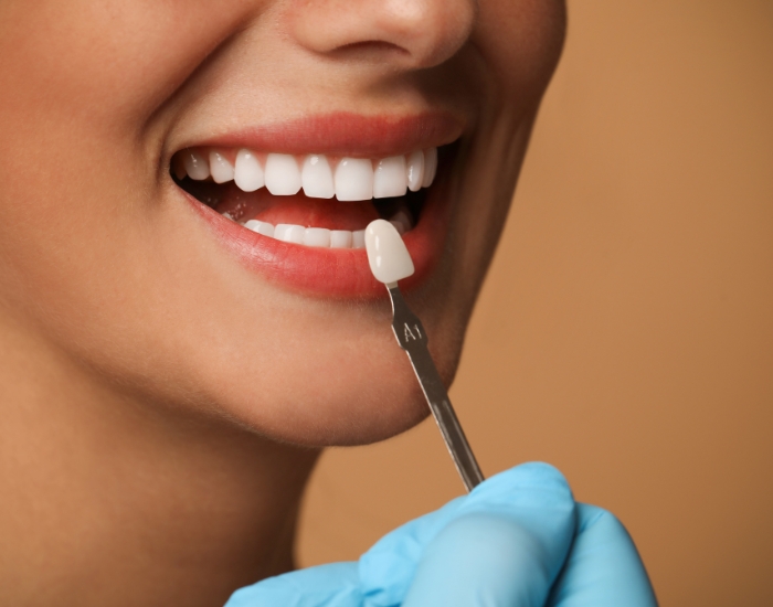 veneers cost