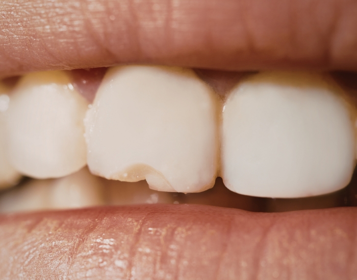 Chipped Front Teeth
