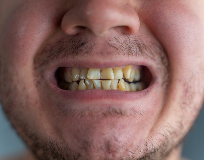 worn teeth