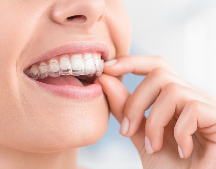 Adult Invisalign Treatment