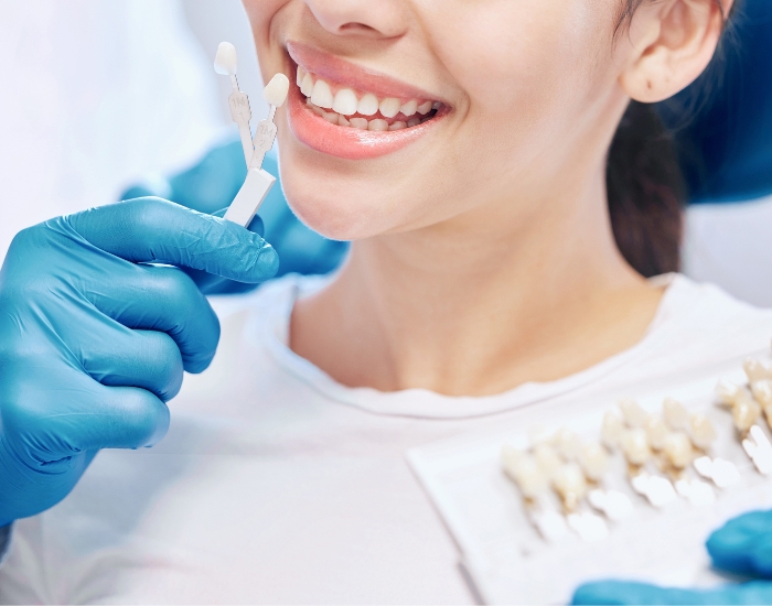 Veneers
