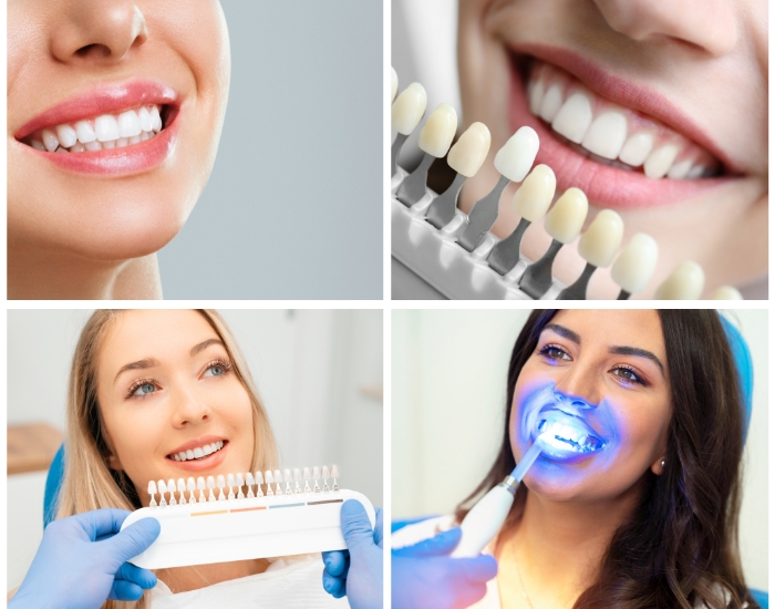 Should I get whitening or veneers?