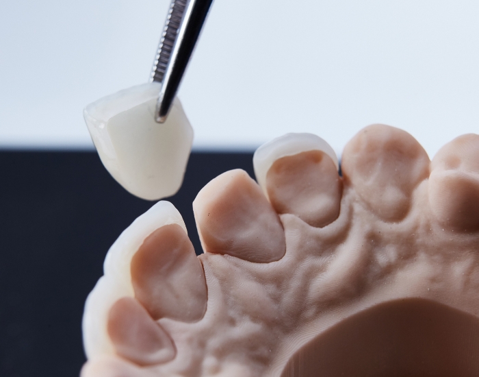 Reasons for Veneers