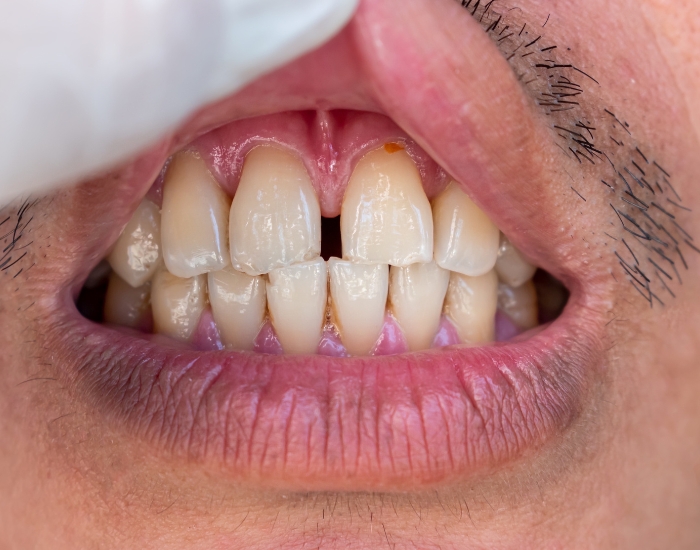 Veneers for Gapped Teeth