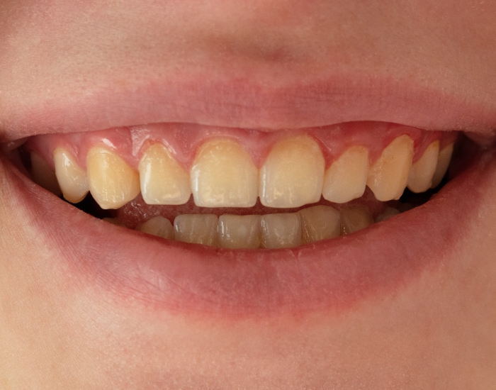 Discolored Teeth