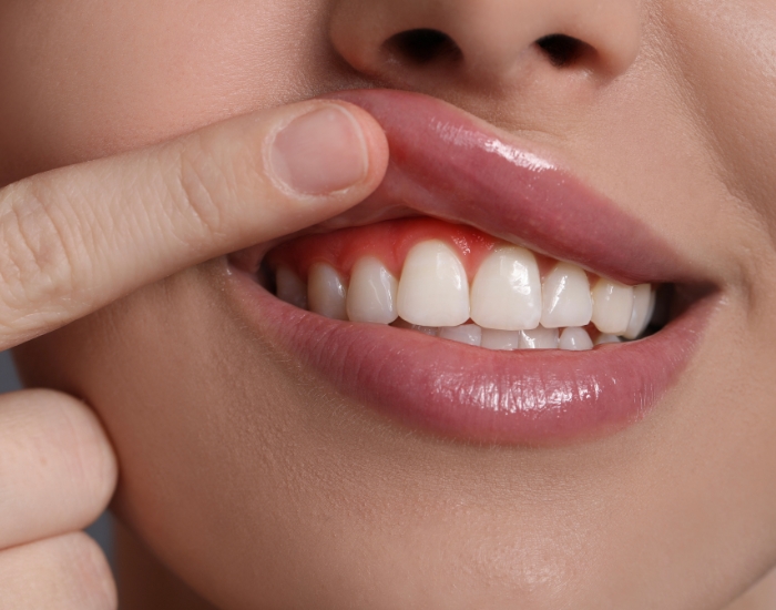 Gummy Smile Treatment