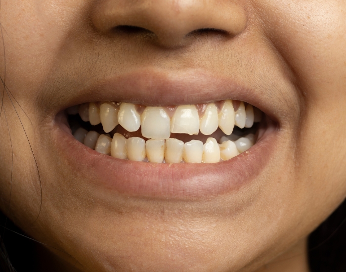 Uneven Tooth